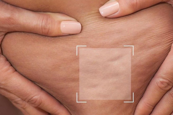 Les différents types de cellulite