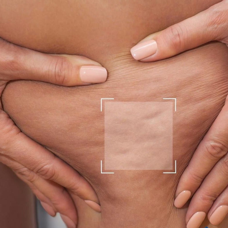 Les différents types de cellulite