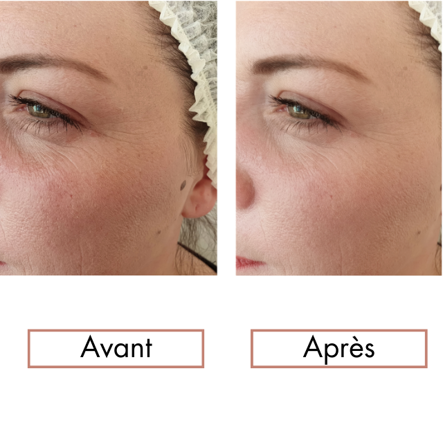 Formation en ligne  Maderothérapie faciale